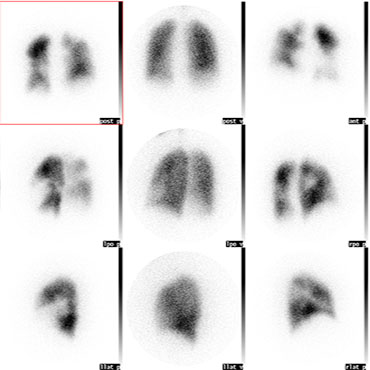 Specialized Medical Imaging & Therapy | V/Q Scan (Lung Scintigraphy ...